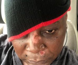 Charly Boy Sustains Injuries In Scooter Accident